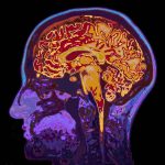 Half of Six-Year Old's Brain Shut Off by Surgeons